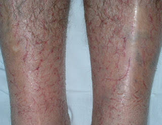 La psoriasis blyashki sobre los codos que arreglar